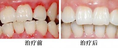 牙周治疗案例5