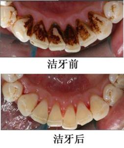 洁牙案例6
